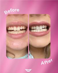 Hismile v34 Colour Corrector Tooth Stain Removal Booster