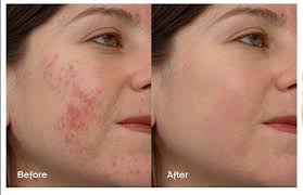 The Ordinary Niacinamide 10% + Zinc 1% (30ml)