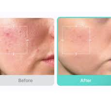 Medicube Azelaic Acid 16% BB Calming Serum