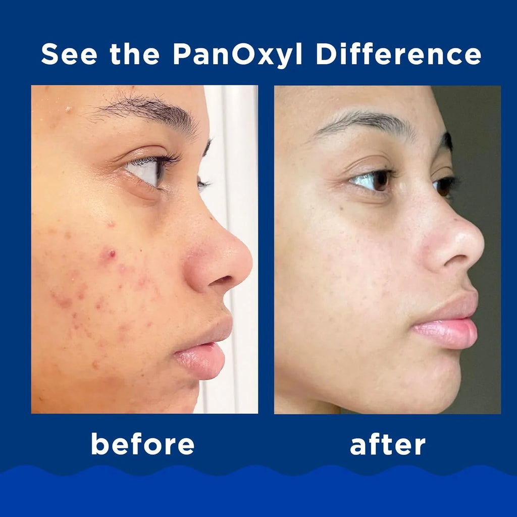 PanOxyl Acne Creamy Wash 4% – Nettoyant Crème Anti-Acné